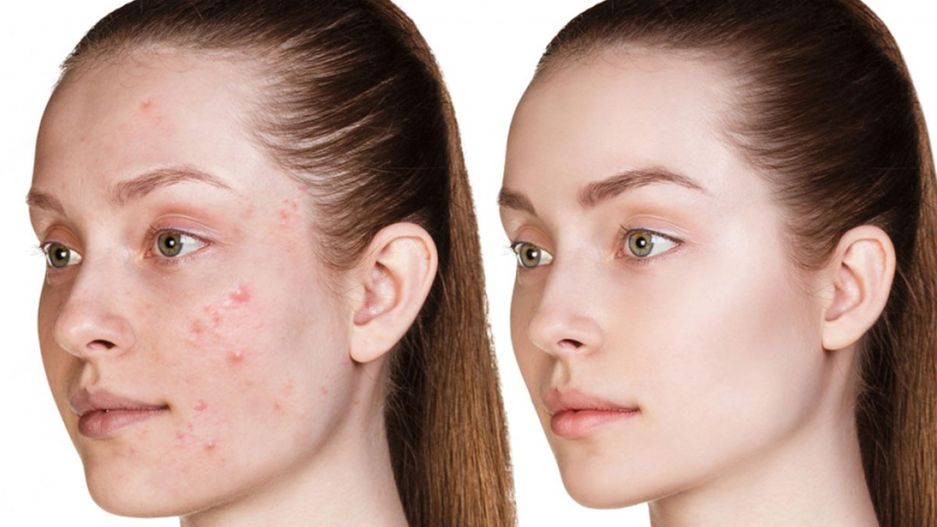 Прыщи лице девочка 10 лет. Прыщи лице девочка 10 лет. Отшелушивание кожи лица. Девушка с проблемной кофей. Подростковая косметология.