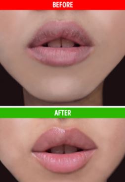 يعالج تشقق الشفاه