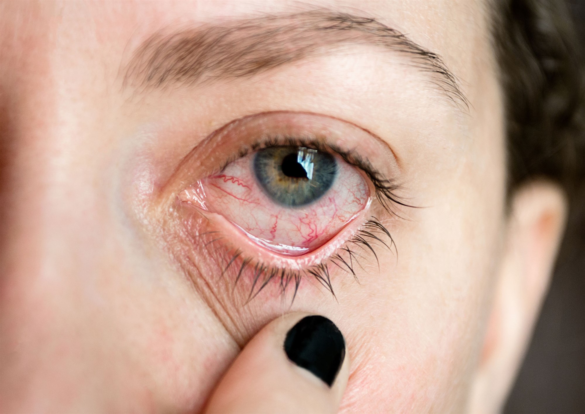 هل احمرار العيون عند الاستيقاظ تعد مشكلة صحية خطيرة؟ إليك الإجابة | حلوة
