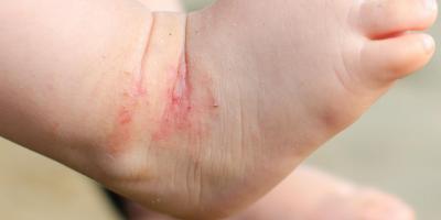 أكزيما الأطفال الرضّع