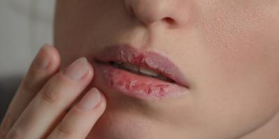 تعانين من الشفاه المتشققة في رمضان.. إليك الحل!