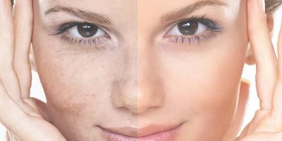 كيف أزيل بقع الصبغة من الجلد؟ إليك 6 طرق لتحقيق ذلك