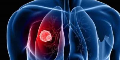 سرطان الرئة .. إليك الأنواع والأسباب وطرق الوقاية