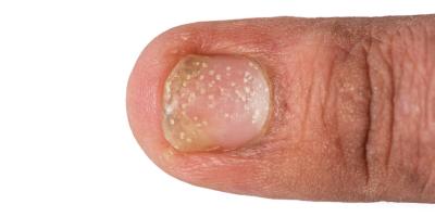 5 طرق منزلية تساعد علي الوقاية من صدفية الأظافر .. تعرفي عليها