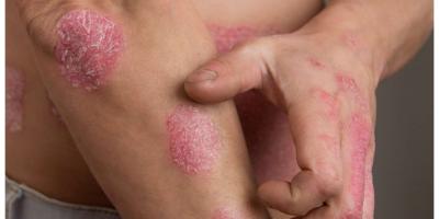  أطعمة ومشروبات يجب على مرضى الصدفية تجنبها