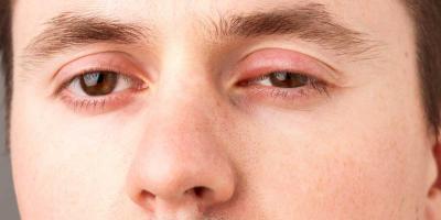 علاجات طبيعية لانتفاخ العين