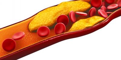 نصائح لخفض الكوليسترول في الدم وعلاجات طبيعية لارتفاعه