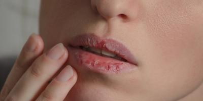ودّعي شفاهك المتشققة.. إليكِ 3 علاجات منزلية بسيطة