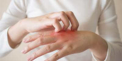 هل يمكن أن يعالج صابون حليب الماعز الأكزيما؟