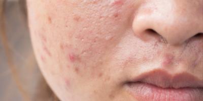 تعانين من حب الشباب.. إليكِ ما يكشفه موقعها عن صحتك