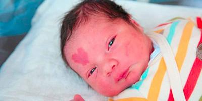 ما هي الطرق المناسبة التي يمكن من خلالها إزالة الوحمة؟