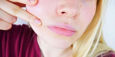 التجاعيد حول الفم.. الأسباب والعلاج