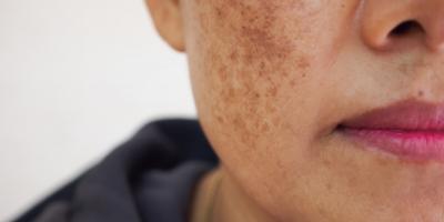 هل هناك رابط بين حبوب منع الحمل والكلف؟ 