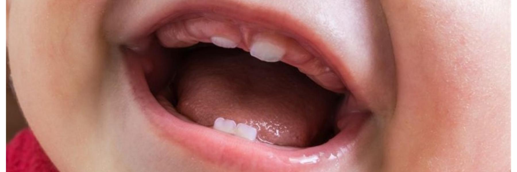 حساسية الفم لدى الأطفال