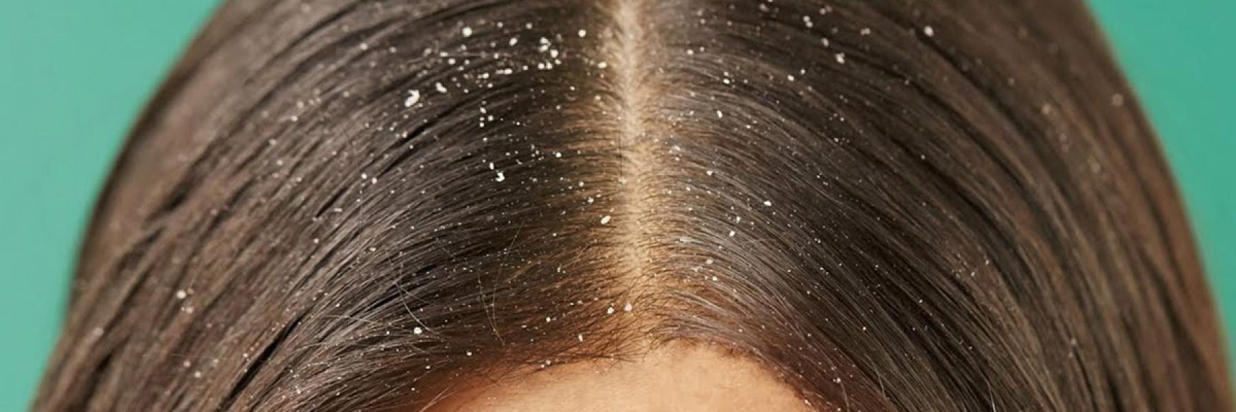 ظهور قشرة الشعر: الأسباب، الأعراض، طرق العلاج