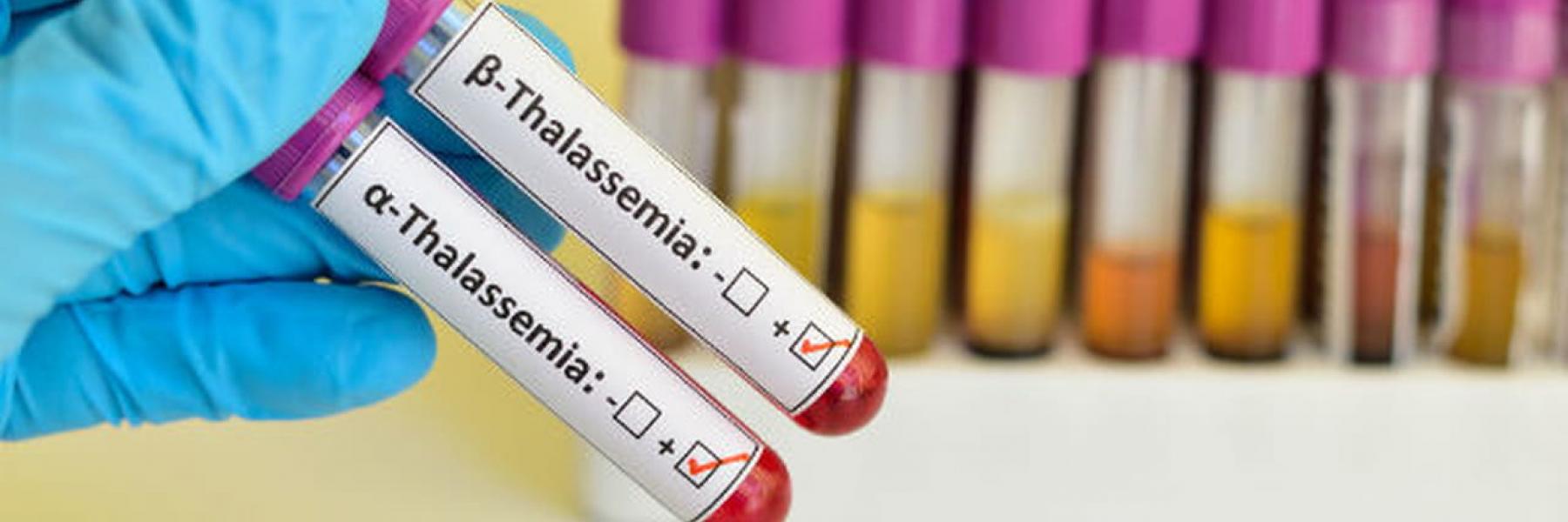 علاج وراثي جديد يحمل الأمل لملايين المصابين بالثلاسيميا