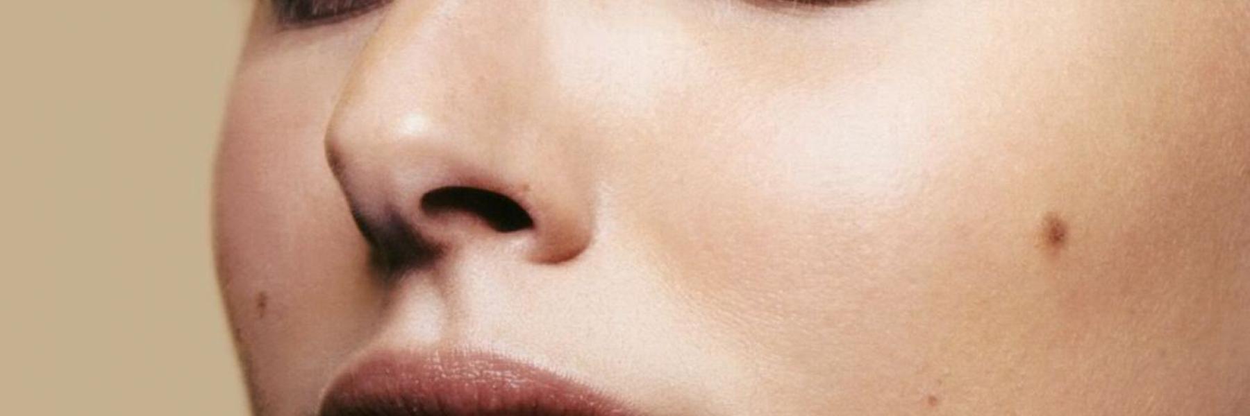 5 علاجات طبيعية فعالة لإزالة شامة الوجه.. تعرف عليها (صور)