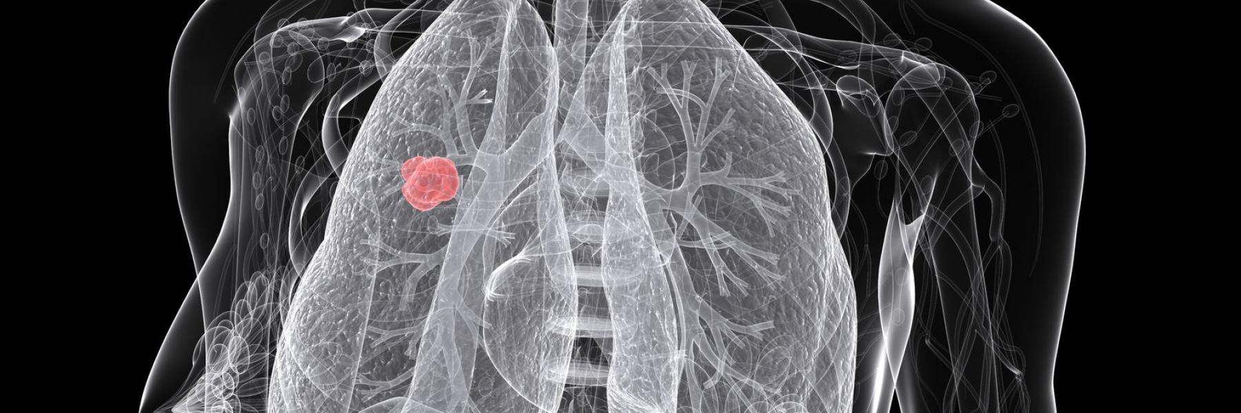 خرافات ومعلومات زائفة عن سرطان الرئة