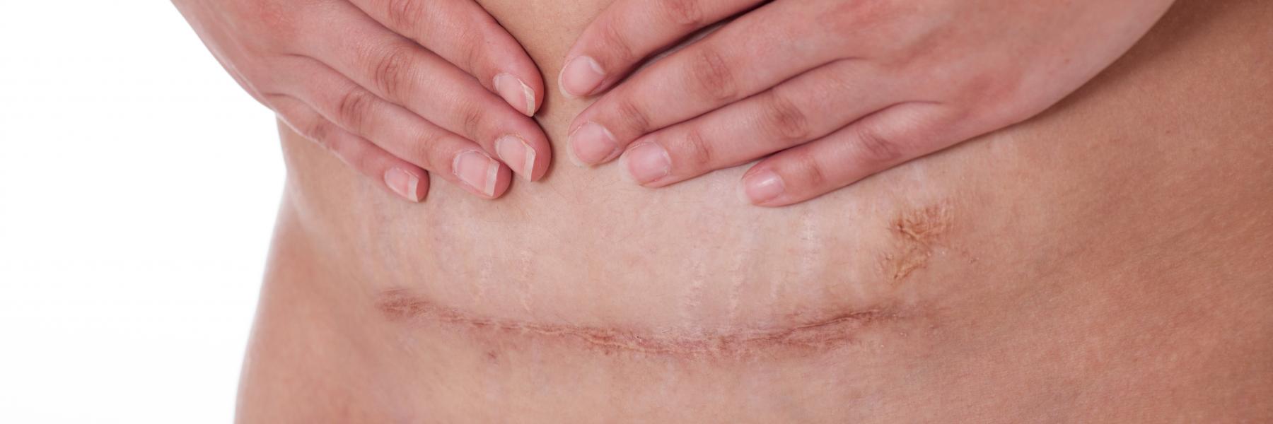 اعرفي كيف تتخلصين من تورم عضلات البطن بعد القيصرية حلوة