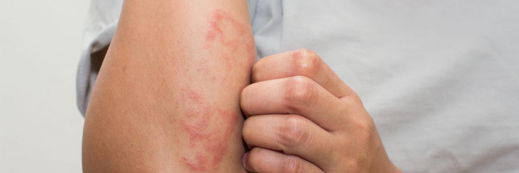هل يعد الطفح الجلدي علامة من علامات الإصابة بكوفيد-19؟