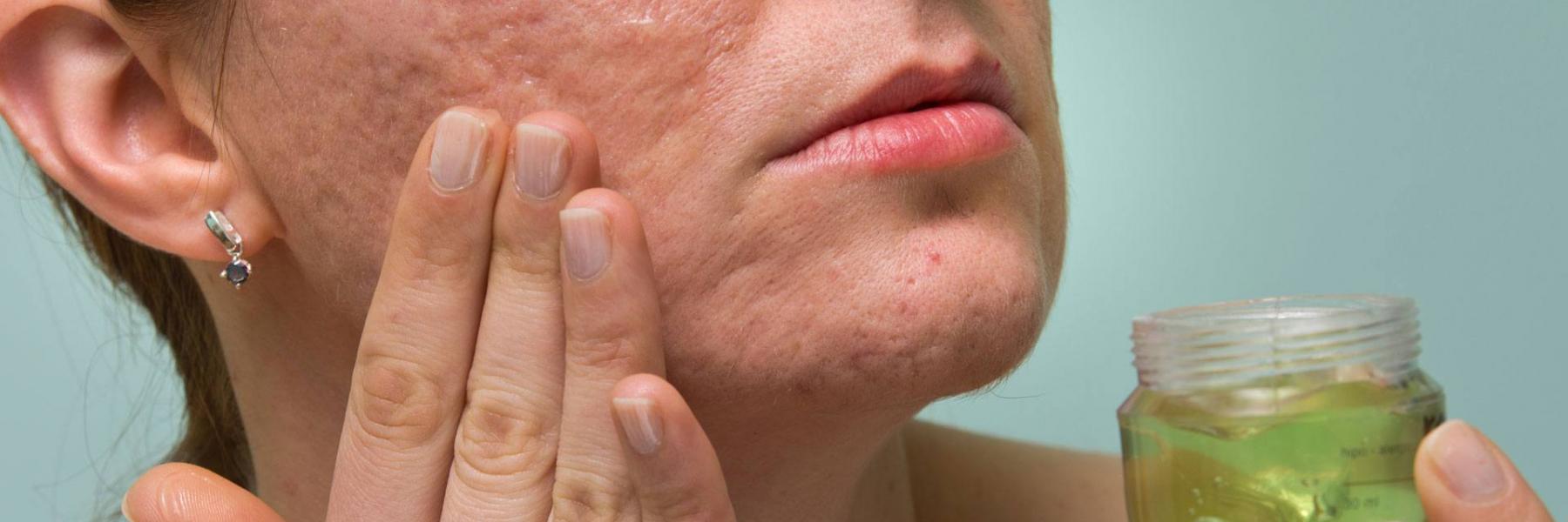 علاجات طبيعية لإزالة ندوب وجروح الوجه