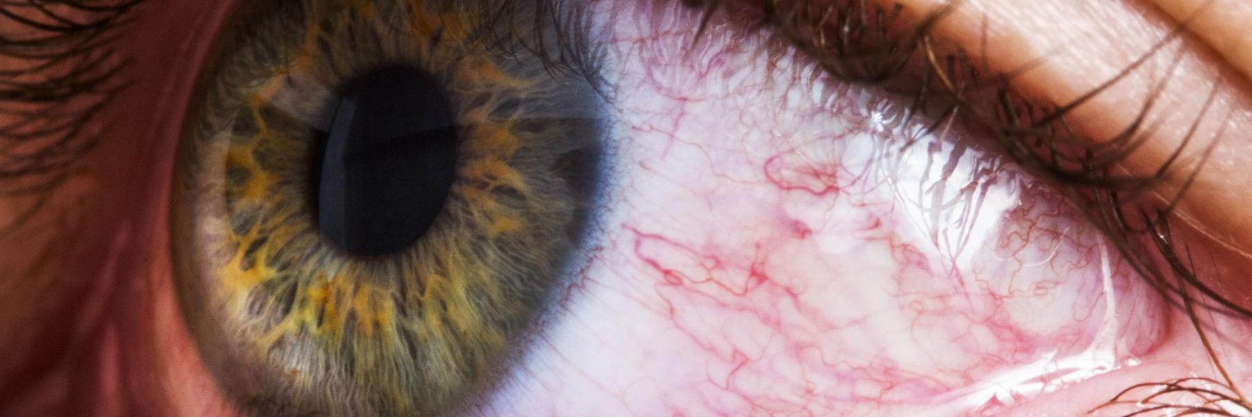 نصائح بسيطة لتخفيف التهابات العين الوردية.. تعرف عليها