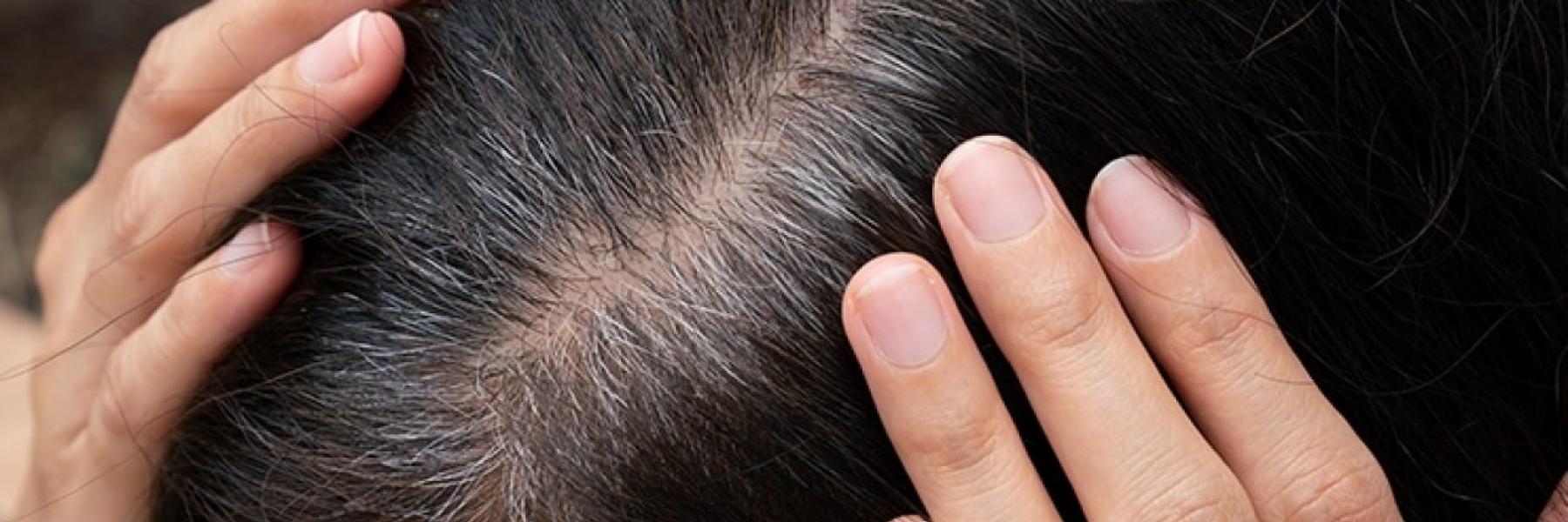 home-remedies-for-premature-graying-of-hair-feat-1280x720.jpg