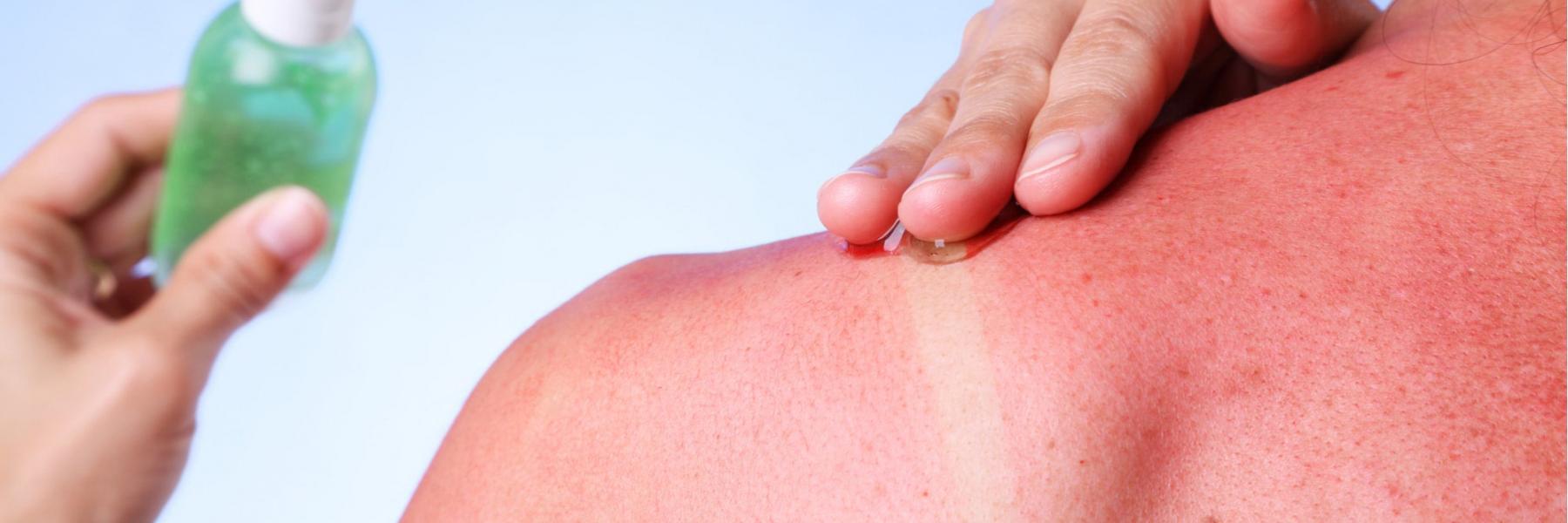 علاجات منزلية لمعالجة أضرار أشعة الشمس على البشرة والشعر