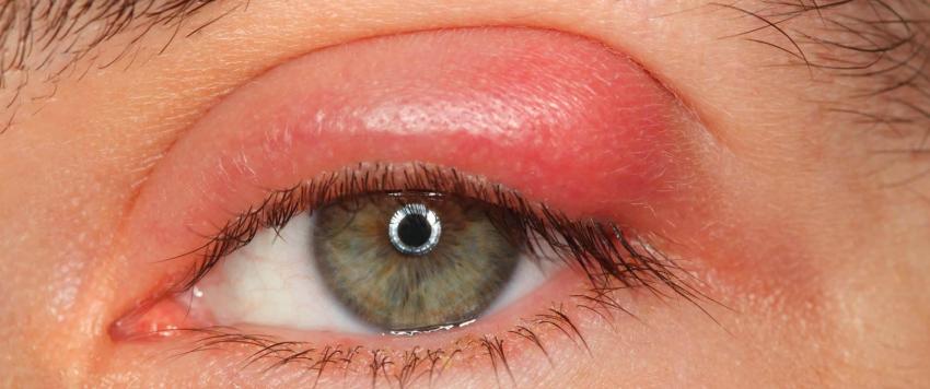 نصائح لعلاج التهاب الجفون بشكل طبيعي دون أدوية