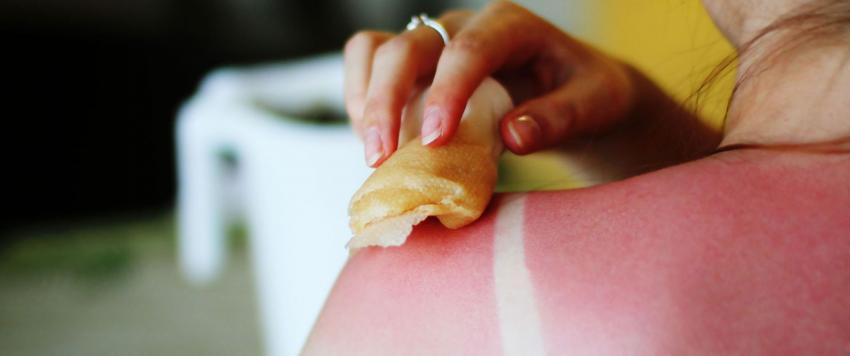 أطعمة لمعالجة حروق البشرة!