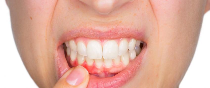 التهاب اللثة