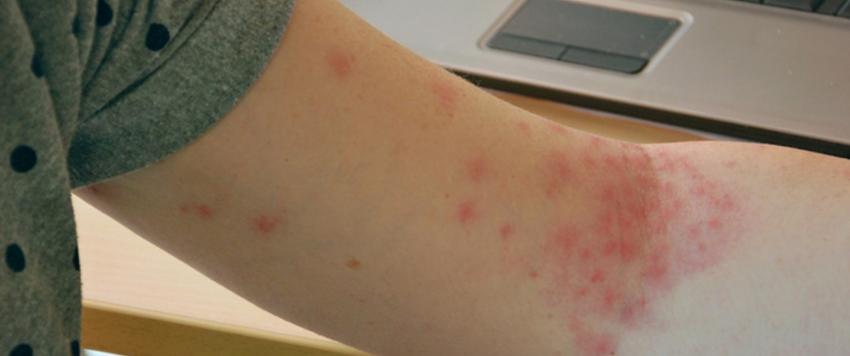 الطفح الجلدي
