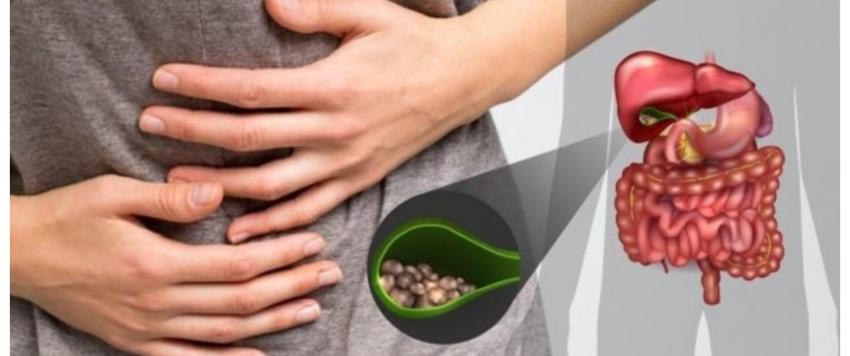 استئصال المرارة