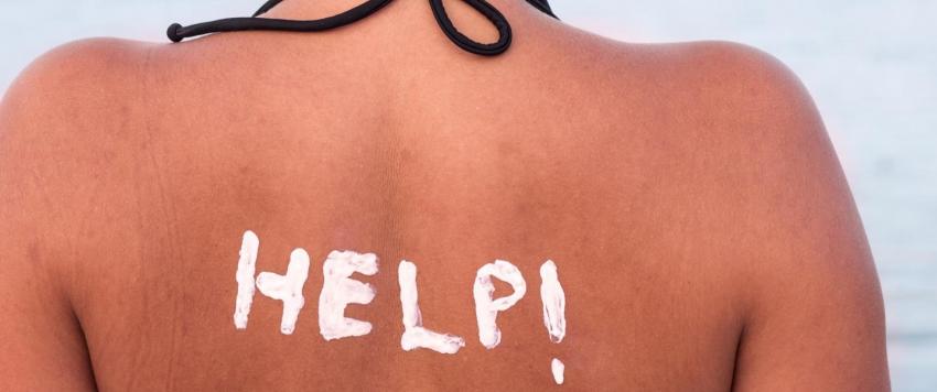 حروق الشمس.. أنواعها وطرق علاجها منزليًا