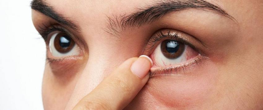 نصائح لعلاج التهاب الجفون بشكل طبيعي دون أدوية