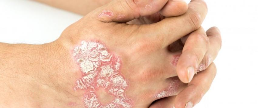 مرض الصدفية