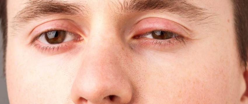 انتفاخ العيون