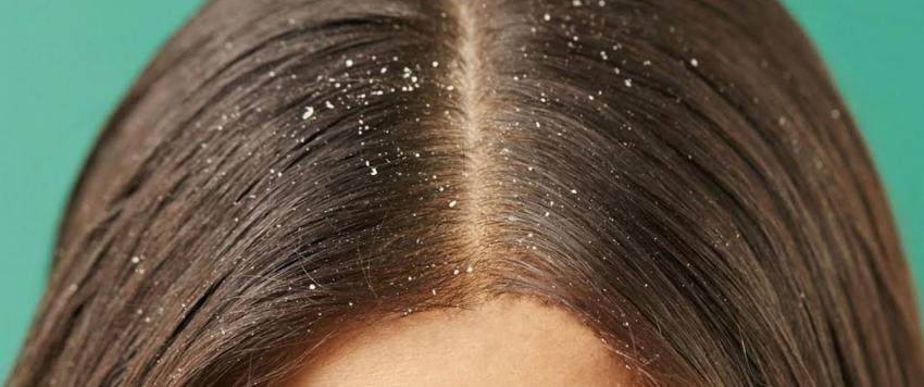 6 علاجات منزلية للتخلص من قشرة الرأس بشكل طبيعي