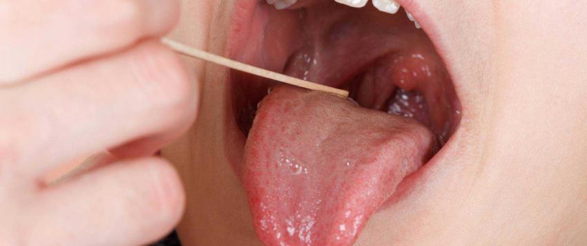 حصى اللوزتين