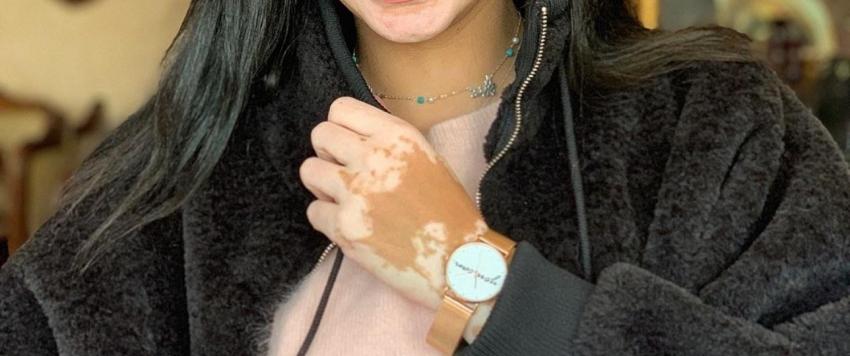 5 خرافات حول مرض البهاق لا يجب تصديقها