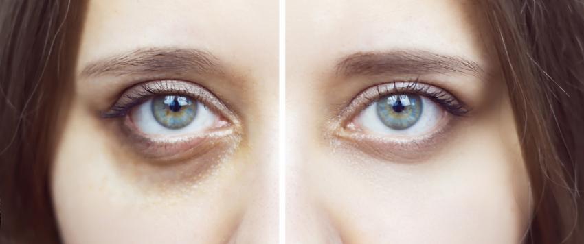 الهالات االسوداء