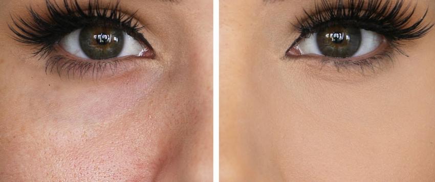 مسامات الوجه مسامات الوجه