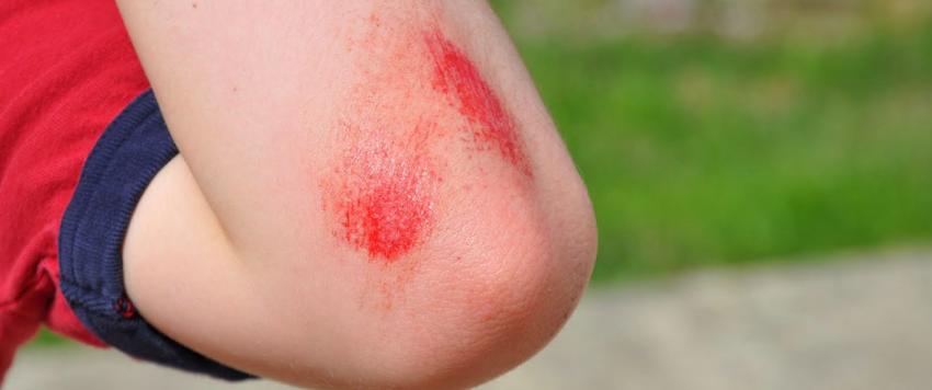 6 من طرق علاج الجروح المتقيحة والملتهبة بشكل طبيعي في المنزل