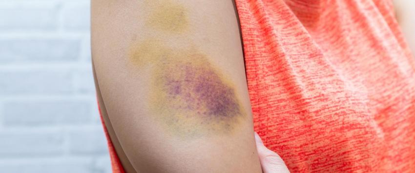 10 علاجات منزلية فعالة للتخلص من كدمات الجسم.. تعرفي عليها