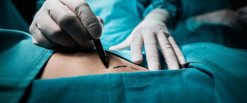 ابتكار كاميرا لتصوير الأورام السرطانية خلال الجراحة