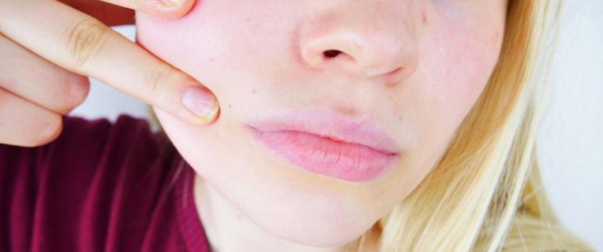 تجاعيد الفم