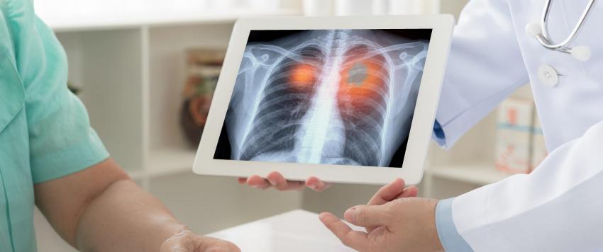 سرطان الرئة