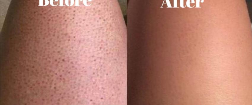 حالة رجل الفراولة الجلدية 