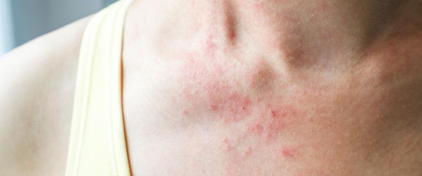 الطفح الجلدي التوتري