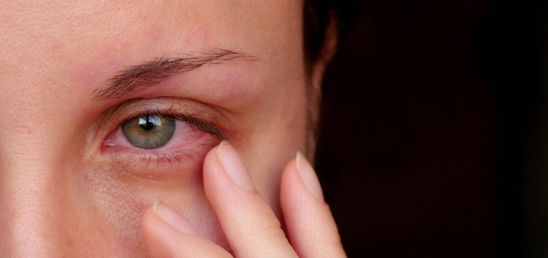 6 طرق بسيطة للتخلص من إحمرار العين بالمنزل